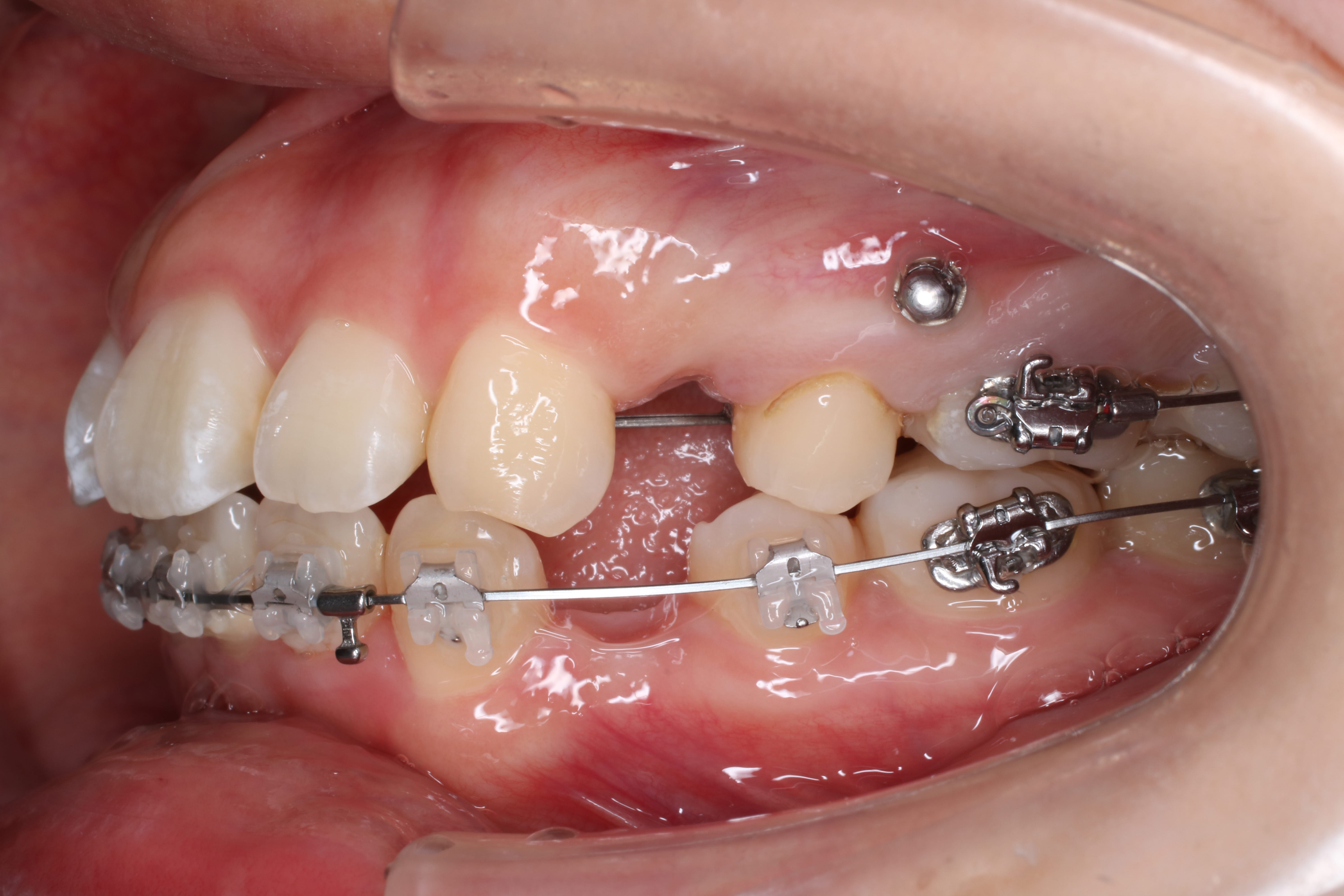 歯 の 矯正 短期 間